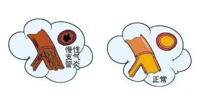 冬季咳嗽反反覆覆不見好？送你三味中藥，化痰消食、降氣平喘