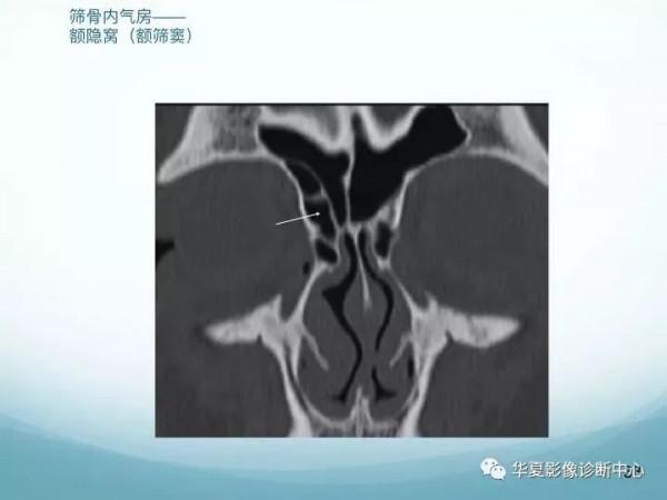 頭頸五官CT斷層解剖圖及常見病影像診斷