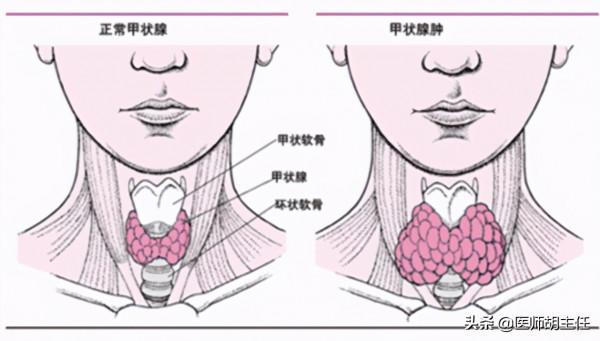 甲狀腺全切後，身體會發生怎樣的變化？哪些情況需要切除甲狀腺？