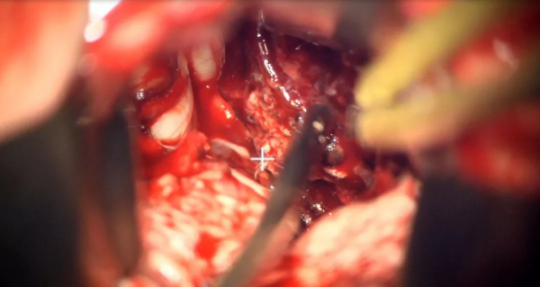 東北地區首例！機器人手術顯微鏡聯合鏡下導航賦能 顯微神經外科手術步入精準切除時代