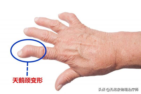 手指發脹、僵硬、握不攏，是風溼嗎？不出意外，這4種可能性較大