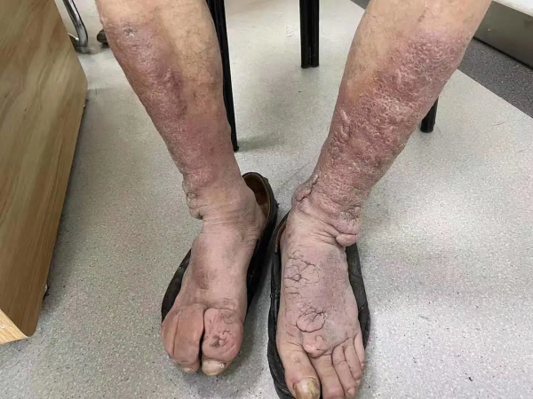 碘131治療甲亢後成甲減，出現嚴重的併發症，如何避免併發症？