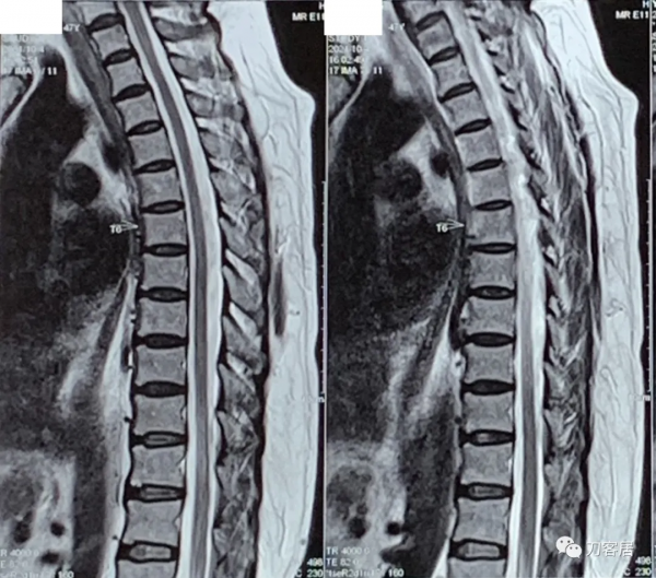 查體的重要性，一直按照腰椎間盤突出症治療的脊髓型頸椎病