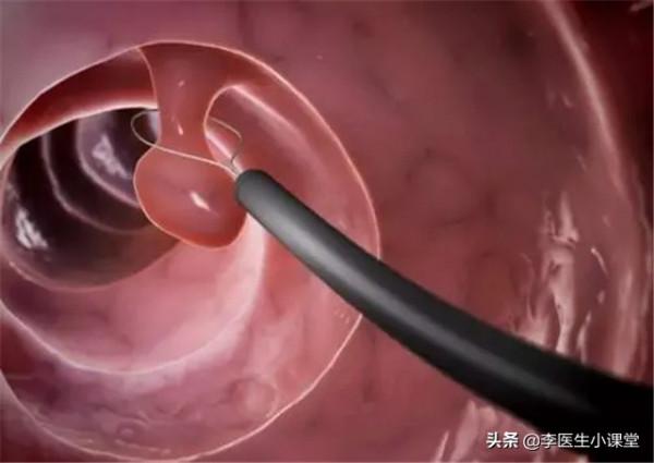 腸鏡能發現早期腸癌,醫生建議:有這3種情況的人,最好定期檢查 腸鏡能發現早期腸癌,醫生建議:有這3種情況的人,最好定期檢查