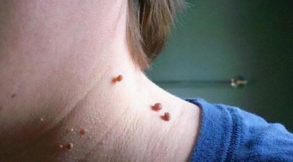 解讀｜面板長出一個個小肉球是怎麼回事，可以摳掉嗎？如何應對？