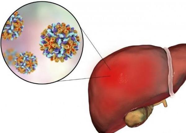 劉渡舟加味柴胡湯治療慢性肝炎晚期 劉渡舟加味柴胡湯治療慢性肝炎晚期