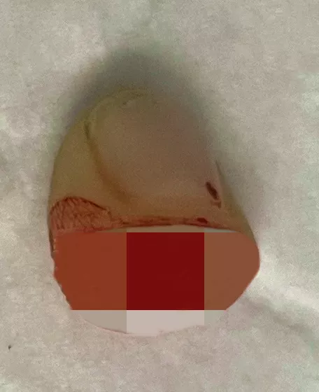 6小時徹夜奮戰保肢成功——北京積水潭醫院手外科完成2022年首例斷肢再植手術