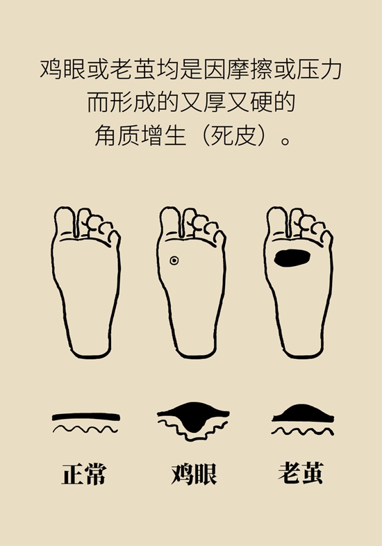 長了雞眼和老繭怎麼辦？這份防治指南請收好
