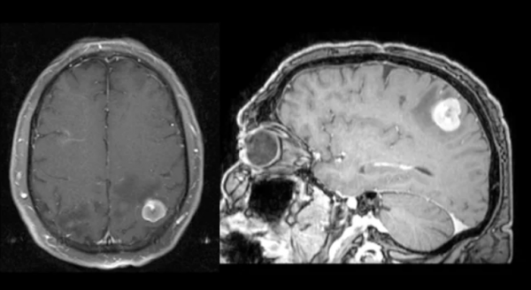 9種腦部病變,一文識別丨臨床必備 9種腦部病變,一文識別丨臨床必備