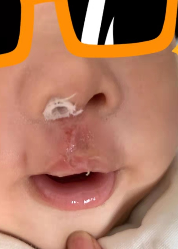 寶寶是一隻“小兔子”，還沒長牙就要開始正畸了