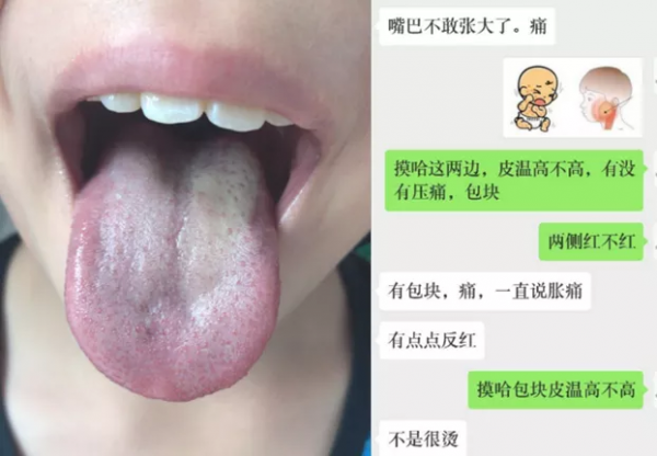 小兒反覆感冒，中醫從脾虛食積論治，療效顯著