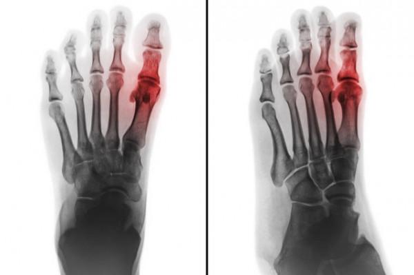 痛風急性發作，吃“消炎藥”有用嗎？