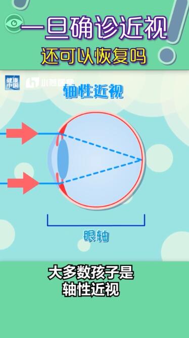 孩子近視都是電子產品惹的禍？近視有沒有可能恢復？權威解答在此，值得收藏