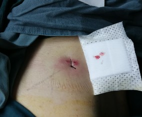 真的嗎?背上打個孔,十多年的腰腿痛就好了 真的嗎?背上打個孔,十多年的腰腿痛就好了