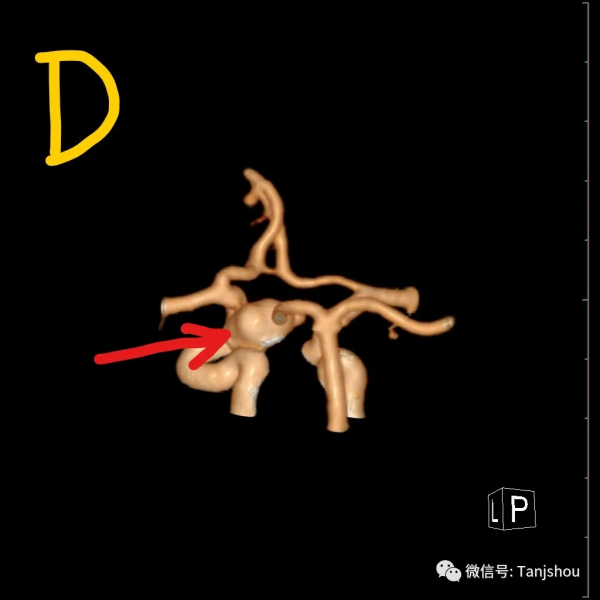 帶你認識“顱內炸彈”