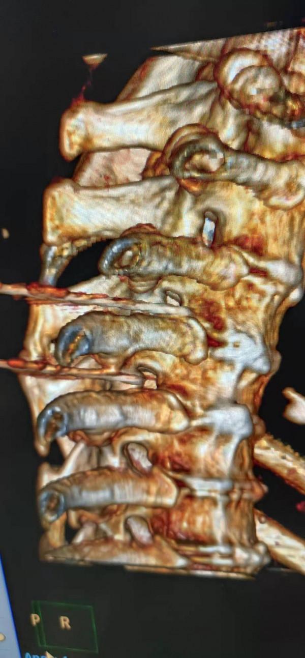南溪山醫院依託3D列印技術為神經痛患者開展射頻治療