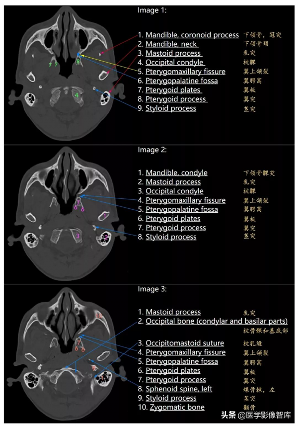 CT斷層解剖圖譜最全總結「推薦收藏」 CT斷層解剖圖譜最全總結「推薦收藏」