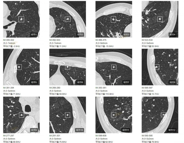肺結節看診（13）：肺小結節全身廣泛轉移2例，PET分期：晚期