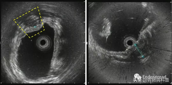 一例有趣的腸道腫物