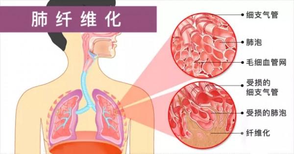 肺部纖維化應該如何治療 需要注意什麼問題