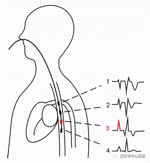 “食道心電圖、食道調搏” 您瞭解嗎? “食道心電圖、食道調搏” 您瞭解嗎?