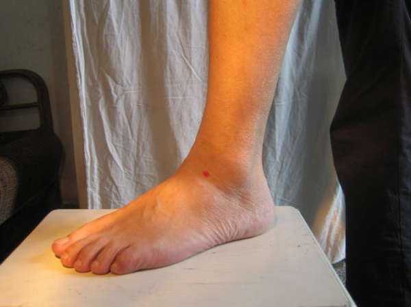 平衡針灸真人穴位演示，都是乾貨，值得收藏