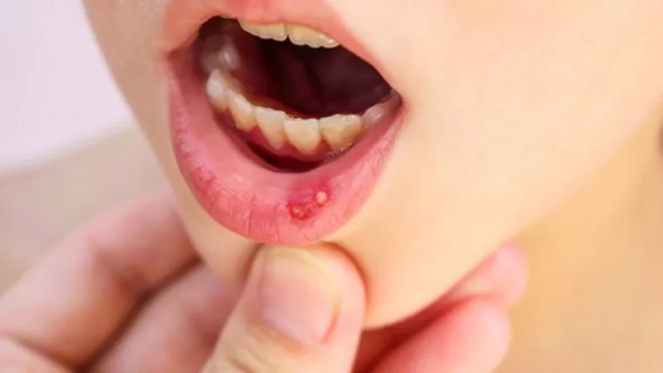 煩煩煩！口腔潰瘍經常犯，常用的中成藥看這裡