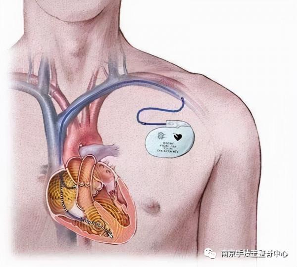 “心臟裝起搏器與裝支架”的患者能進行整脊調理嗎？
