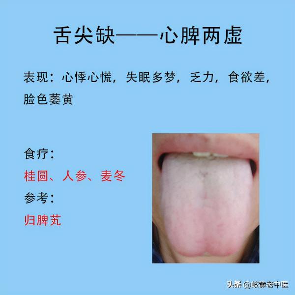 常見六種失眠的舌象，以及解決方法分享，這時候能睡個好覺了