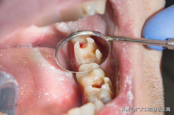 補牙後，牙齒痠痛！老牙醫竟說：正常