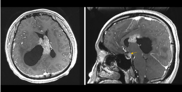 9種腦部病變,一文識別丨臨床必備 9種腦部病變,一文識別丨臨床必備