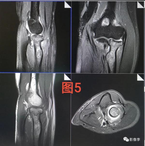 “靜電”與磁共振成像：秋冬季節注意