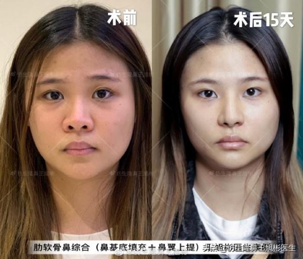 鼻頭縮小可以只“減脂”，不取自體軟骨做支架嗎？