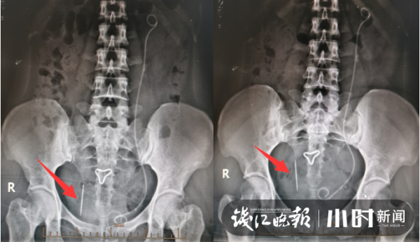 一根“繡花針”竟在女子體內藏了二十多年,醫生:運氣太好了 一根“繡花針”竟在女子體內藏了二十多年,醫生:運氣太好了