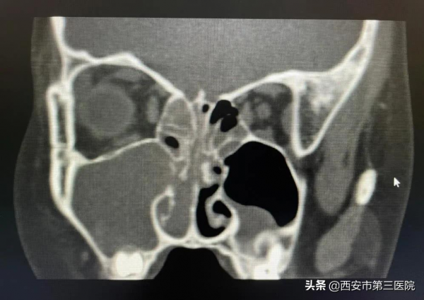 又雙叒叕流鼻血？耳鼻喉科成功切除一例少見兒童出血性鼻息肉