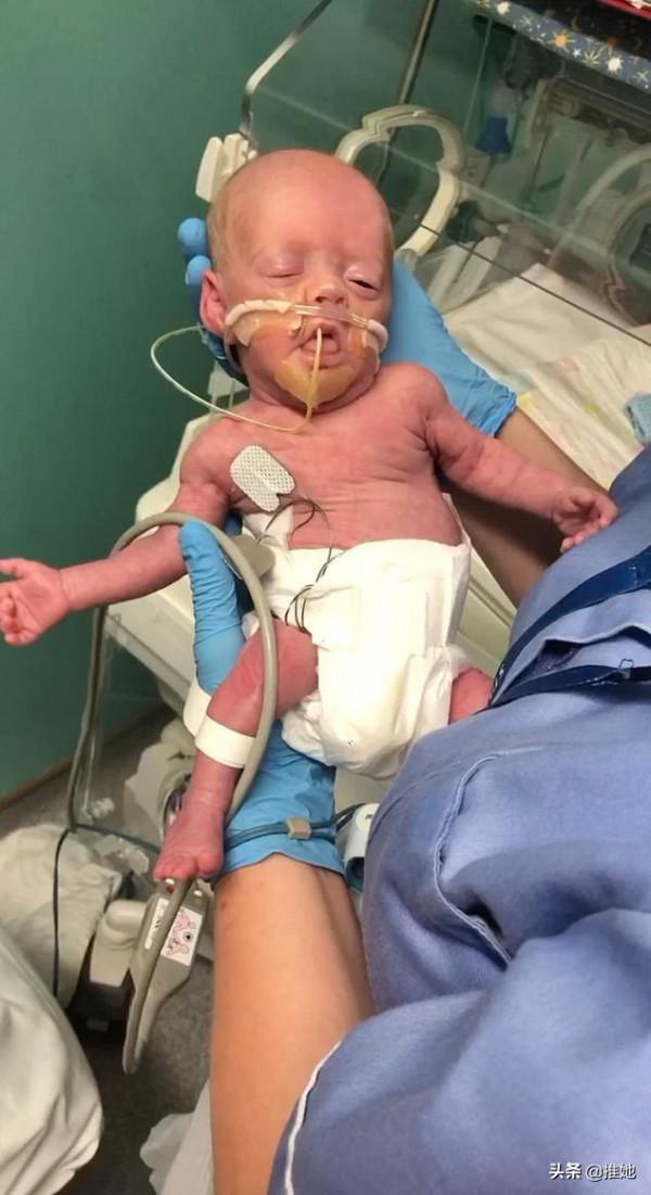 倆胎兒在媽媽子宮裡搶食，弟弟出生時不到1斤重，奇蹟般活了下來