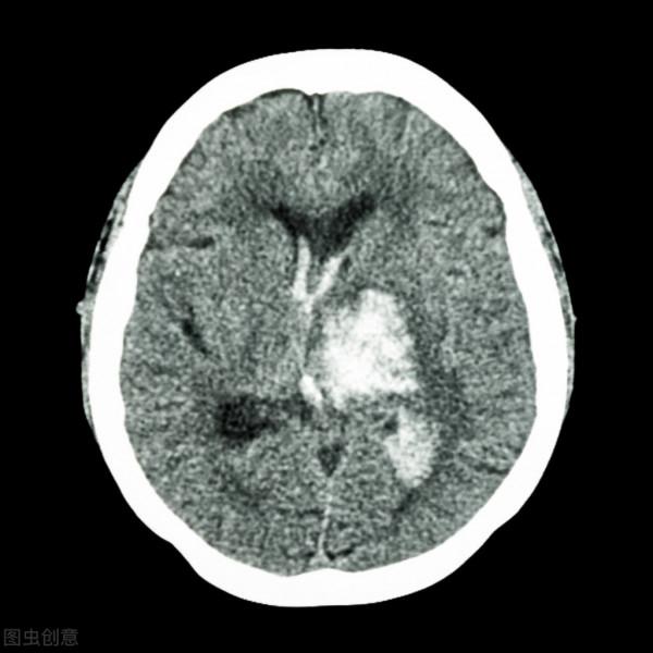 66歲還沒出現腦梗,是什麼水平?醫生:恭喜您,已經及格了 66歲還沒出現腦梗,是什麼水平?醫生:恭喜您,已經及格了