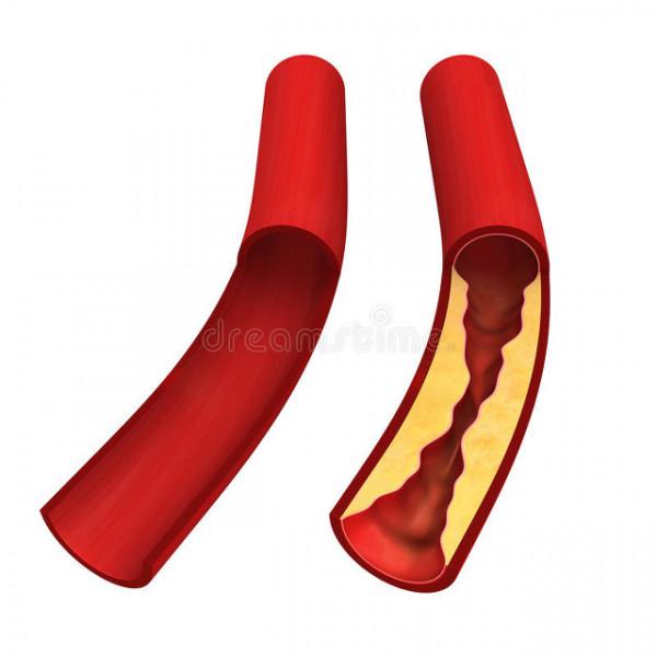 冠心病，一定要長期吃藥嗎？心血管醫生告訴你