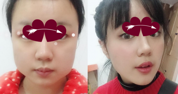 那些“一刀切”削臉的明星還好嗎？有的已垮掉，小方臉成最後贏家