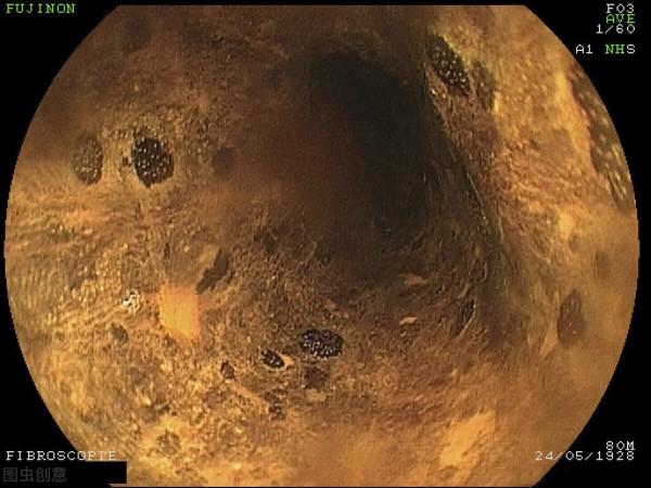 55歲男子咽喉乾燥、發癢，自以為“咽炎”，醫院檢查後男子崩潰了