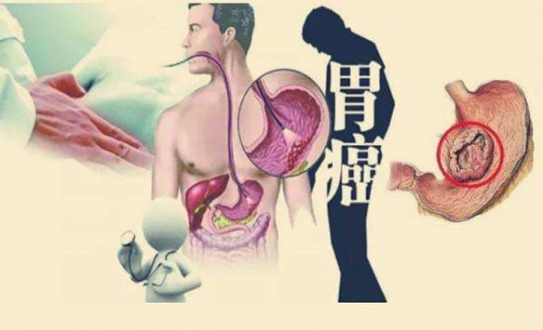 胃癌復發有什麼症狀