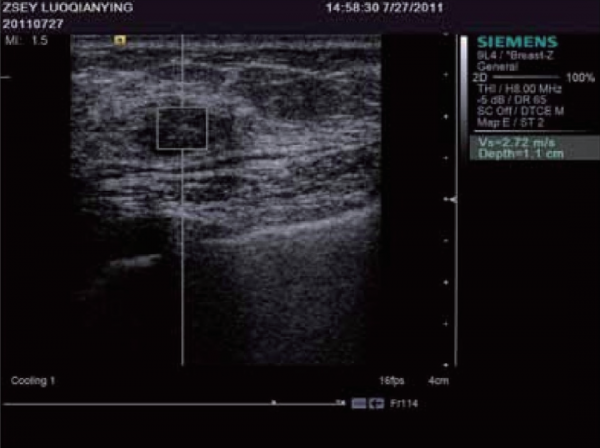 看不見的“手”——聲輻射力及其應用