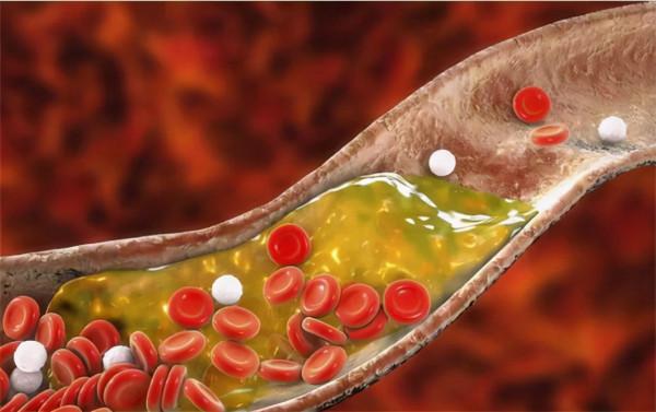 脂肪肝患者的5大飲食原則，想減脂，就按這個原則來