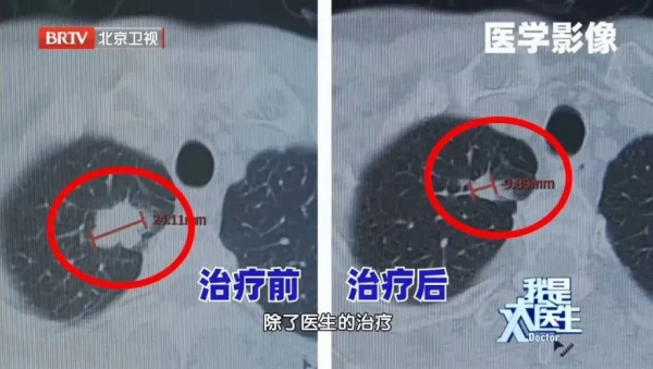 晚期肺癌也能有效“逆轉”？2大肺部“殺手”，就在你身邊