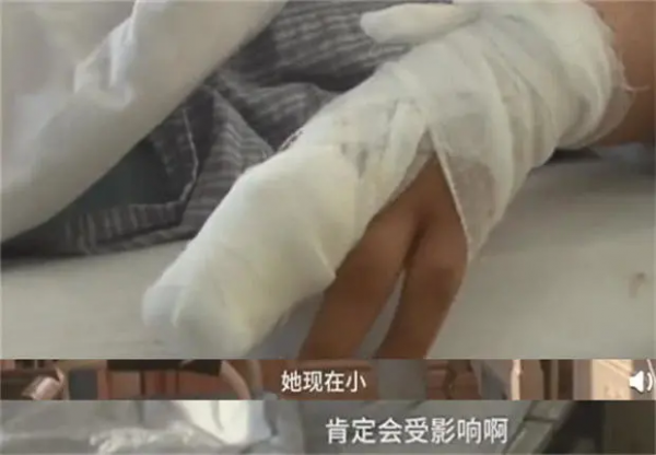 10個月女嬰，被家人刮痧毀了臉