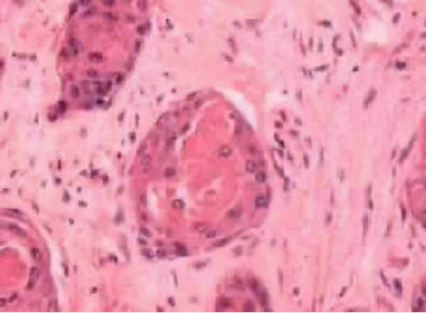 奪走趙忠祥生命的鱗狀細胞癌,聽起來陌生,實際上卻很常見 奪走趙忠祥生命的鱗狀細胞癌,聽起來陌生,實際上卻很常見