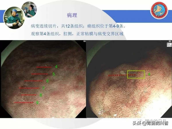 早期胃癌——內鏡診治流程