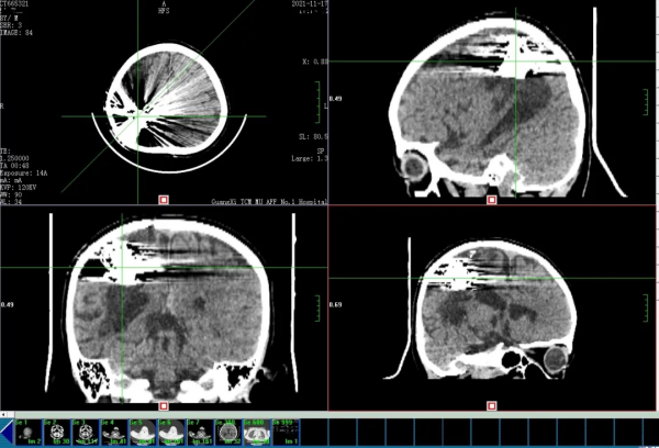 7歲小學生深夜突發腦出血,生死一線!家長疑惑:老年病為何小孩會得?醫生術中找出原因 7歲小學生深夜突發腦出血,生死一線!家長疑惑:老年病為何小孩會得?醫生術中找出原因