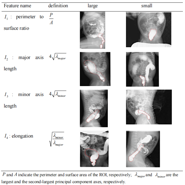 研究提出融合專家評分的先天性巨結腸早期精準輔助診斷方法 研究提出融合專家評分的先天性巨結腸早期精準輔助診斷方法