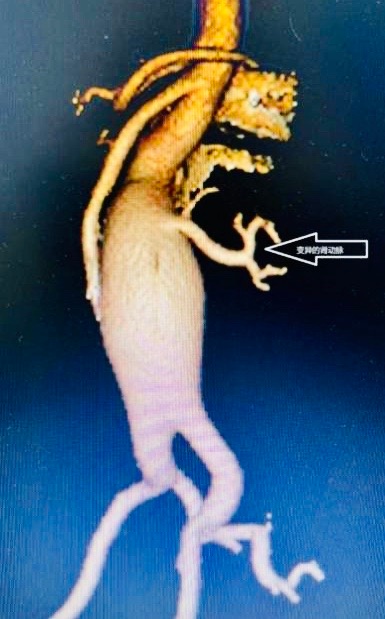 腰痛竟因體內“不定時炸彈”?醫生“拆彈”同時為她做腎“搬家” 腰痛竟因體內“不定時炸彈”?醫生“拆彈”同時為她做腎“搬家”